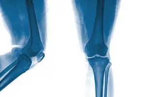 Challenges Facing Joint Replacement Registries