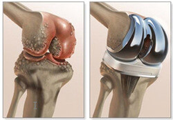 Robotics vs Navigation in Total Joint Surgery Robotics vs Navigation in Total Joint Surgery