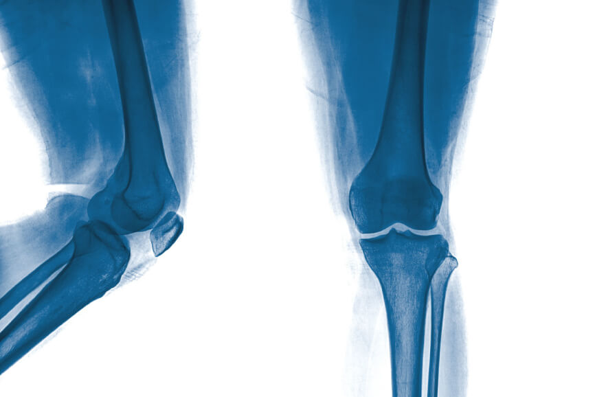 Challenges Facing Joint Replacement Registries Challenges Facing Joint Replacement Registries